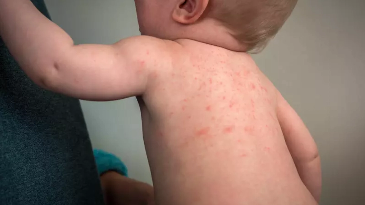 Huiduitslag bij baby's: De meest voorkomende oorzaken en behandelingsmogelijkheden