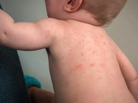 Huiduitslag bij baby's: De meest voorkomende oorzaken en behandelingsmogelijkheden